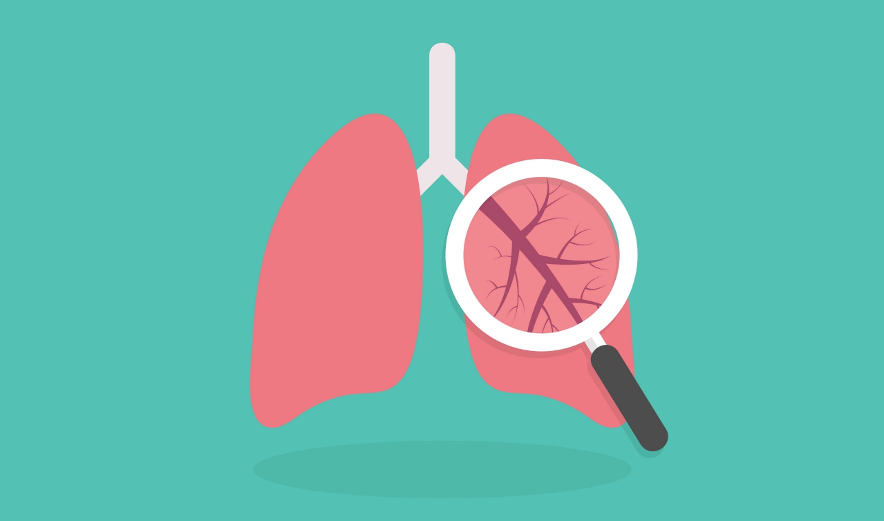 6 Facts You Need to Know About Lung Cancer