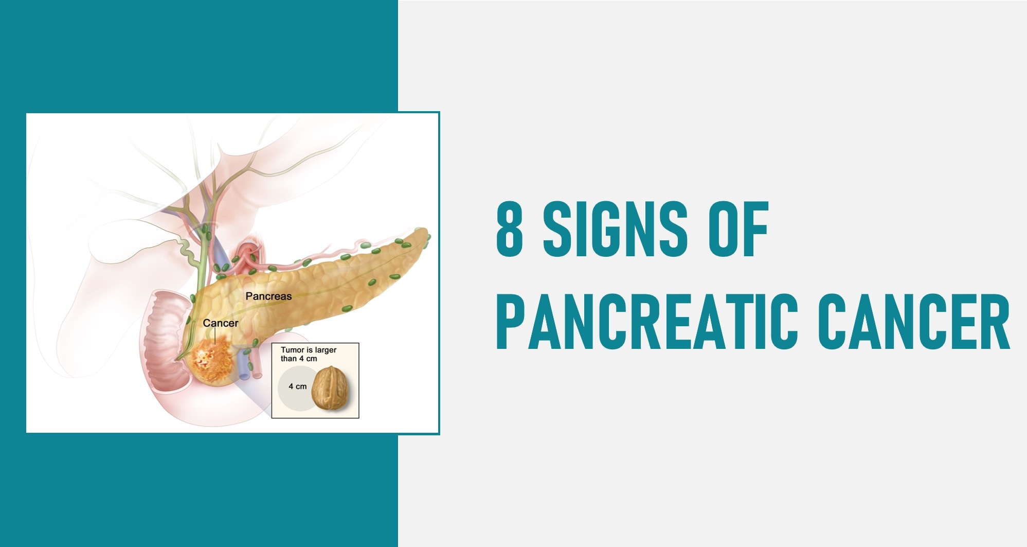 8 Signs of Pancreatic Cancer – Not to Ignore Ever