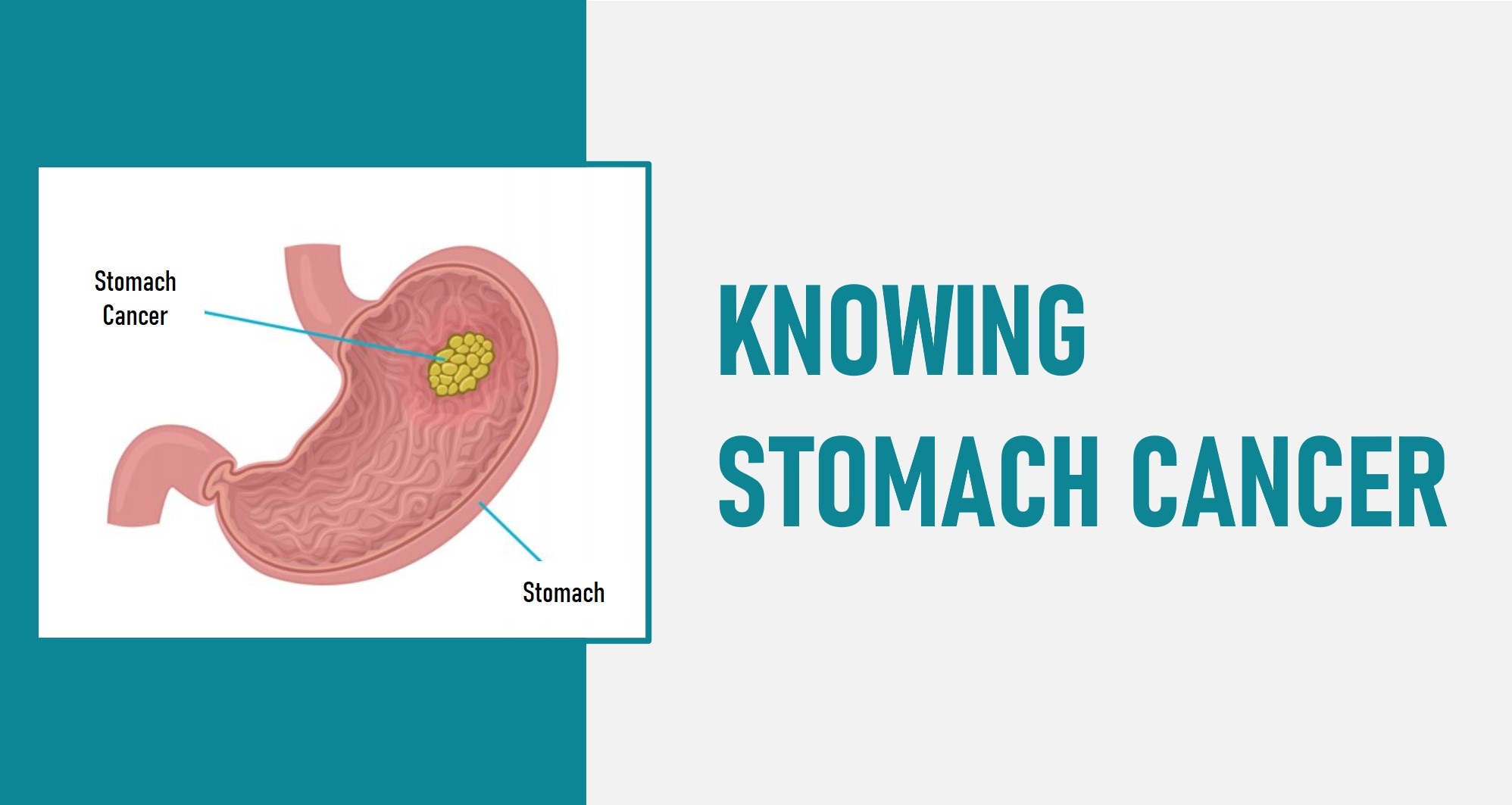 Stomach Cancer (Gastric Cancer) – Causes, Symptoms & Treatments