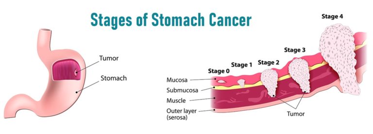 Stomach Cancer (Gastric Cancer) – Causes, Symptoms & Treatments